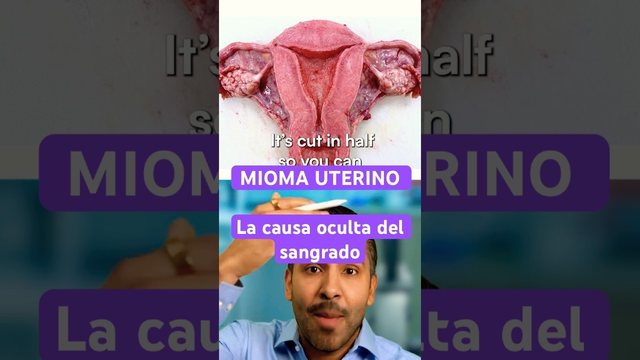 Video thumbnail: Uterine fibroid: the hidden cause of bleeding