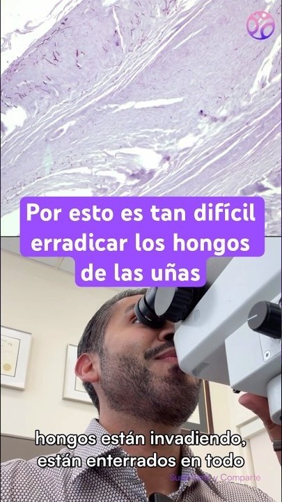 Video thumbnail: Toenail fungus: how we diagnose it